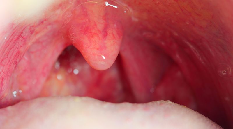 The tonsils are part of the lymphatic system and are vital to the body’s immune response.